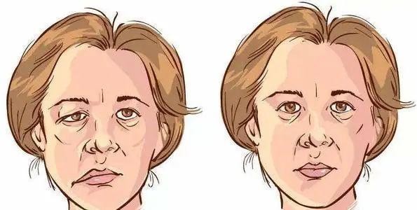 面瘫治疗一个月后的注意事项,得了面瘫怎样保健