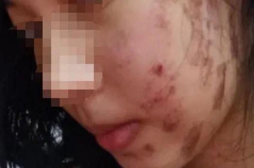 光子嫩肤打完起泡留疤了怎么修复,姑娘做完光子嫩肤后脸上全是黑疤