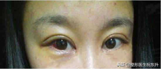 睁眼有神闭眼无痕修复双眼皮,无痕双眼皮眼尾有开口