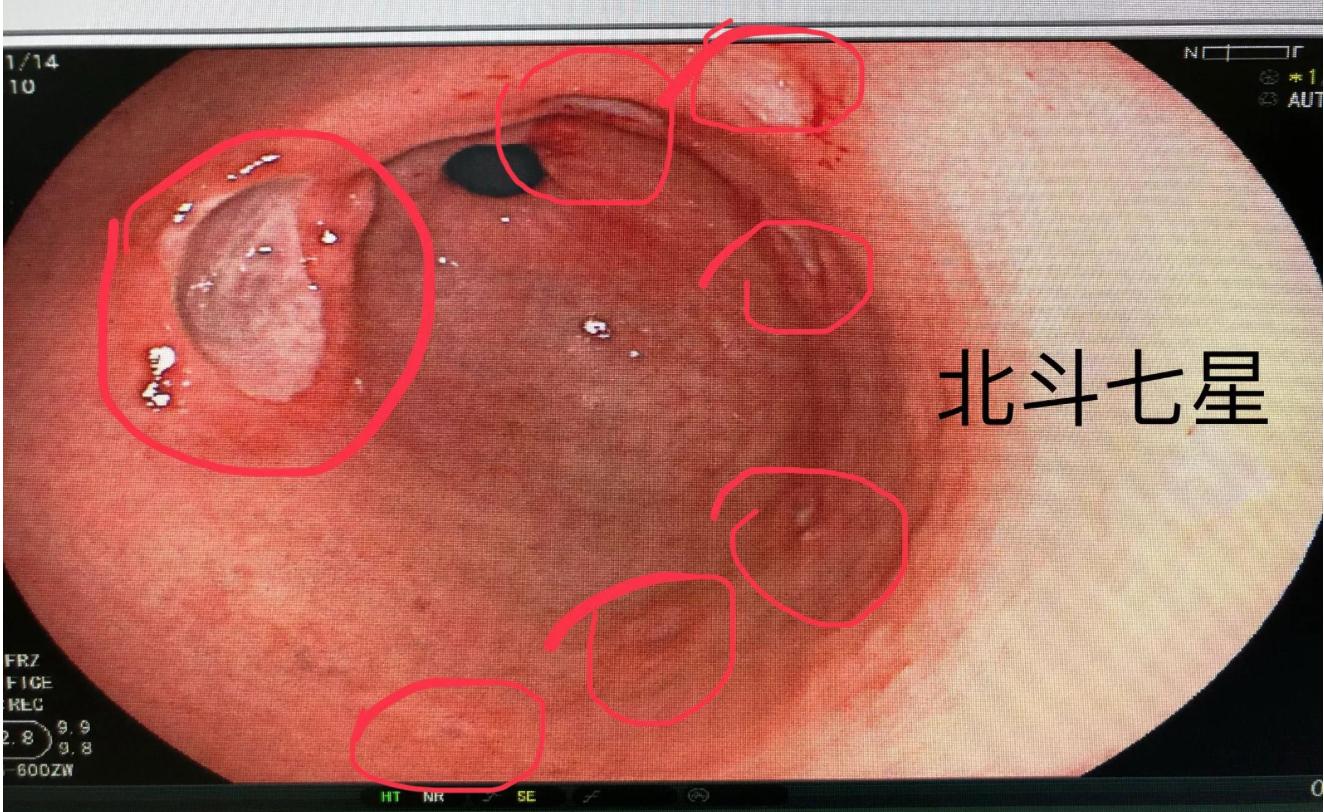 消化性胃溃疡难以消失原因,胃部消化性溃疡会有哪些症状