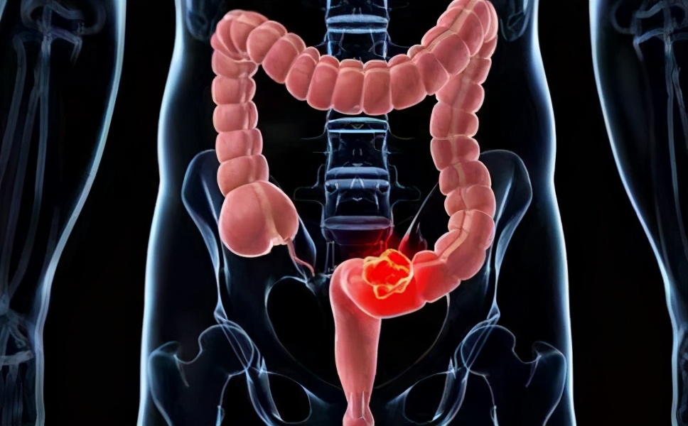 肠镜能判断出来直肠癌严重程度吗,直肠癌早期能通过肠镜发现吗