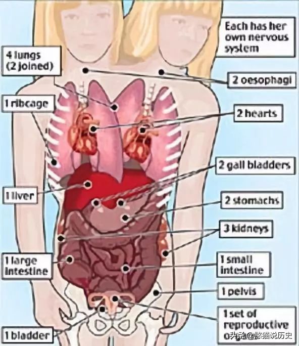 世界上最诡异的双头连体人,两个大脑如何控制同一个身躯