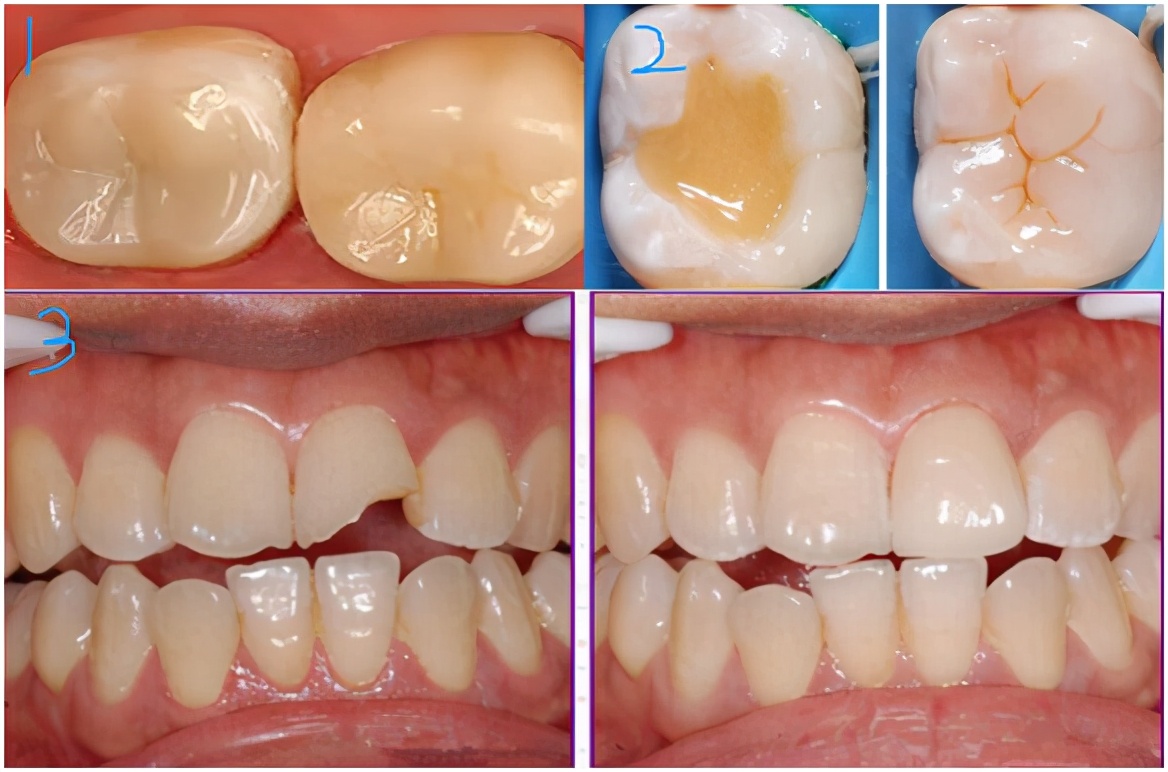 600补一颗牙齿贵吗,诊所补一颗牙多少钱