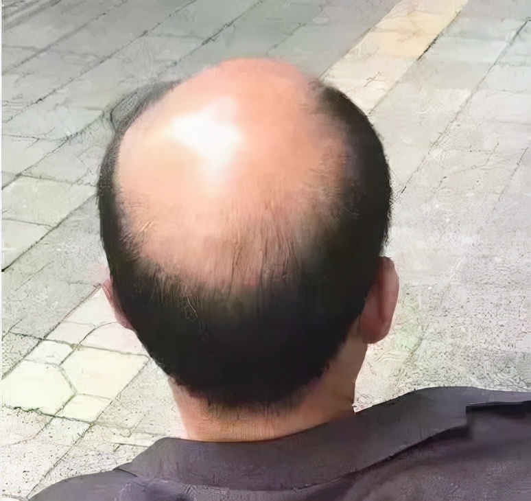 我国2.5亿人“秃了”，科学家找到“元凶”后反而更苦恼，咋回事