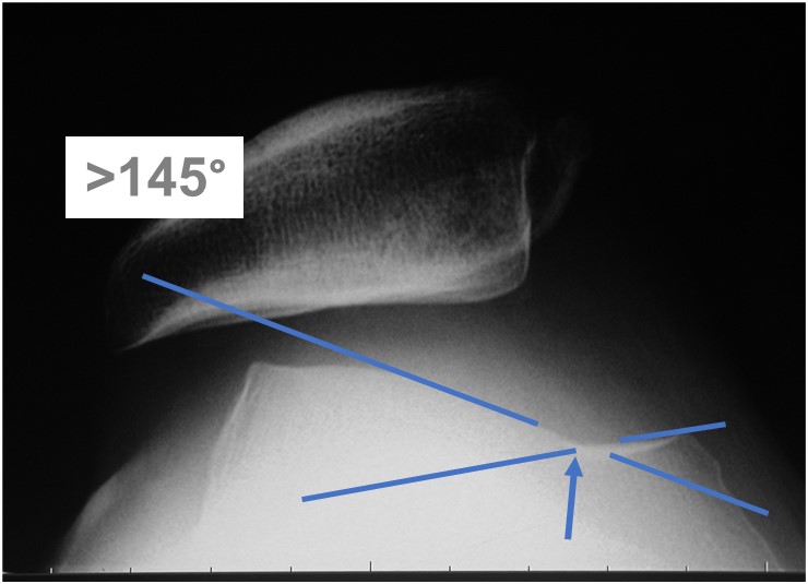髌骨半脱位打石膏能彻底治愈吗,青少年膝盖半月板二级损伤