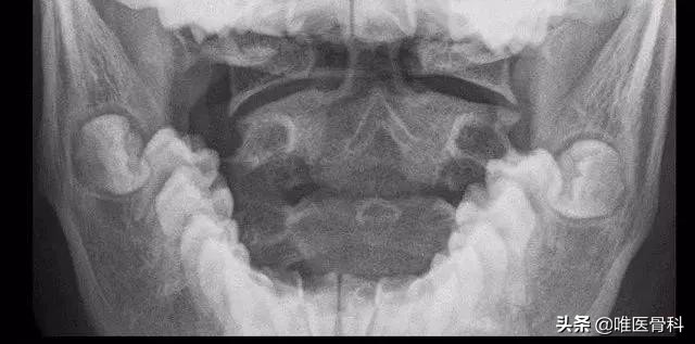 儿子脖子突然不敢往一面歪,孩子突然肩膀一高一低脖子歪