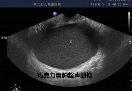 卵巢巧克力囊肿穿刺好还是手术好,穿刺治疗巧克力囊肿效果评价