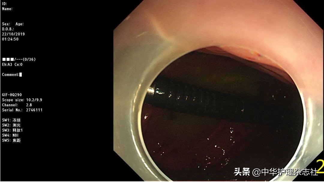 误吸患者护理的应急预案,幼童误吞电池医生顺利取出