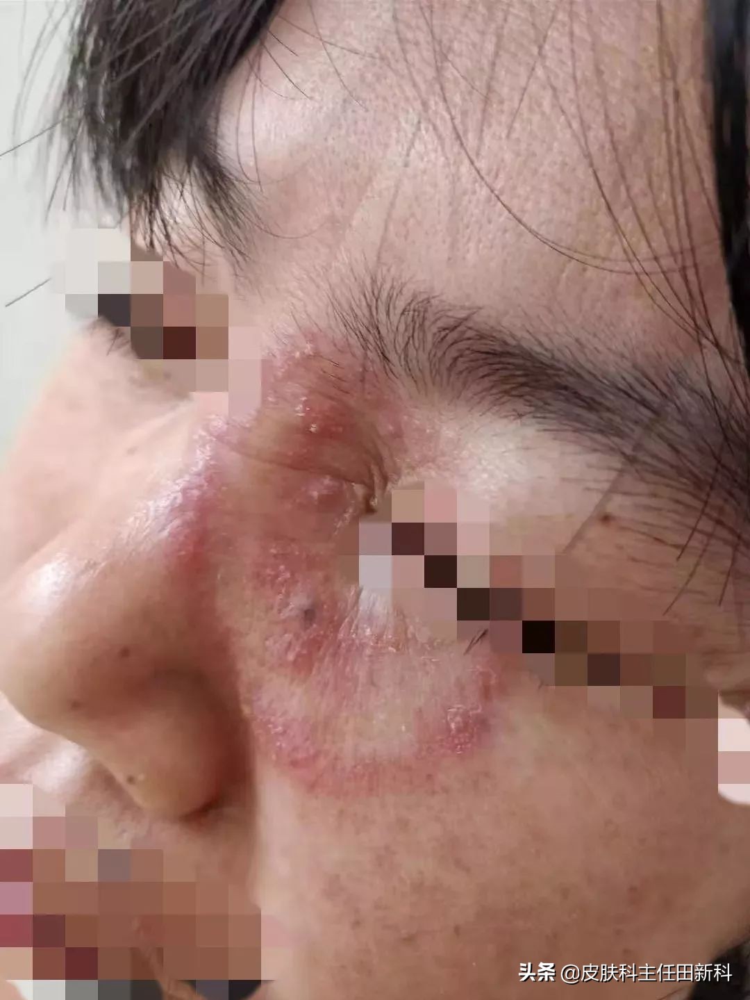 脸上成片斑是哪里出了问题,脸上痘印变成癣了怎么回事