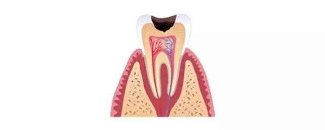 补牙补到牙齿都秃没了,补牙快到牙神经了补完咬合疼