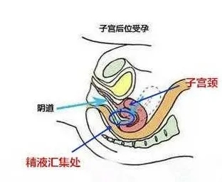 医生说子宫后位有点严重怀孕困难,子宫后位怀孕后会不会有什么影响