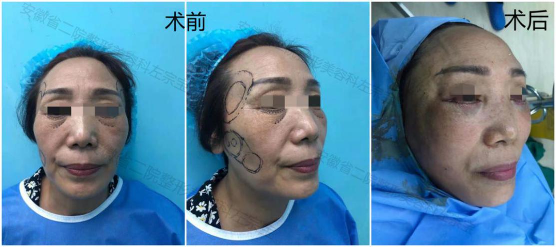 自体脂肪移植除皱,脸部自体脂肪移植整形