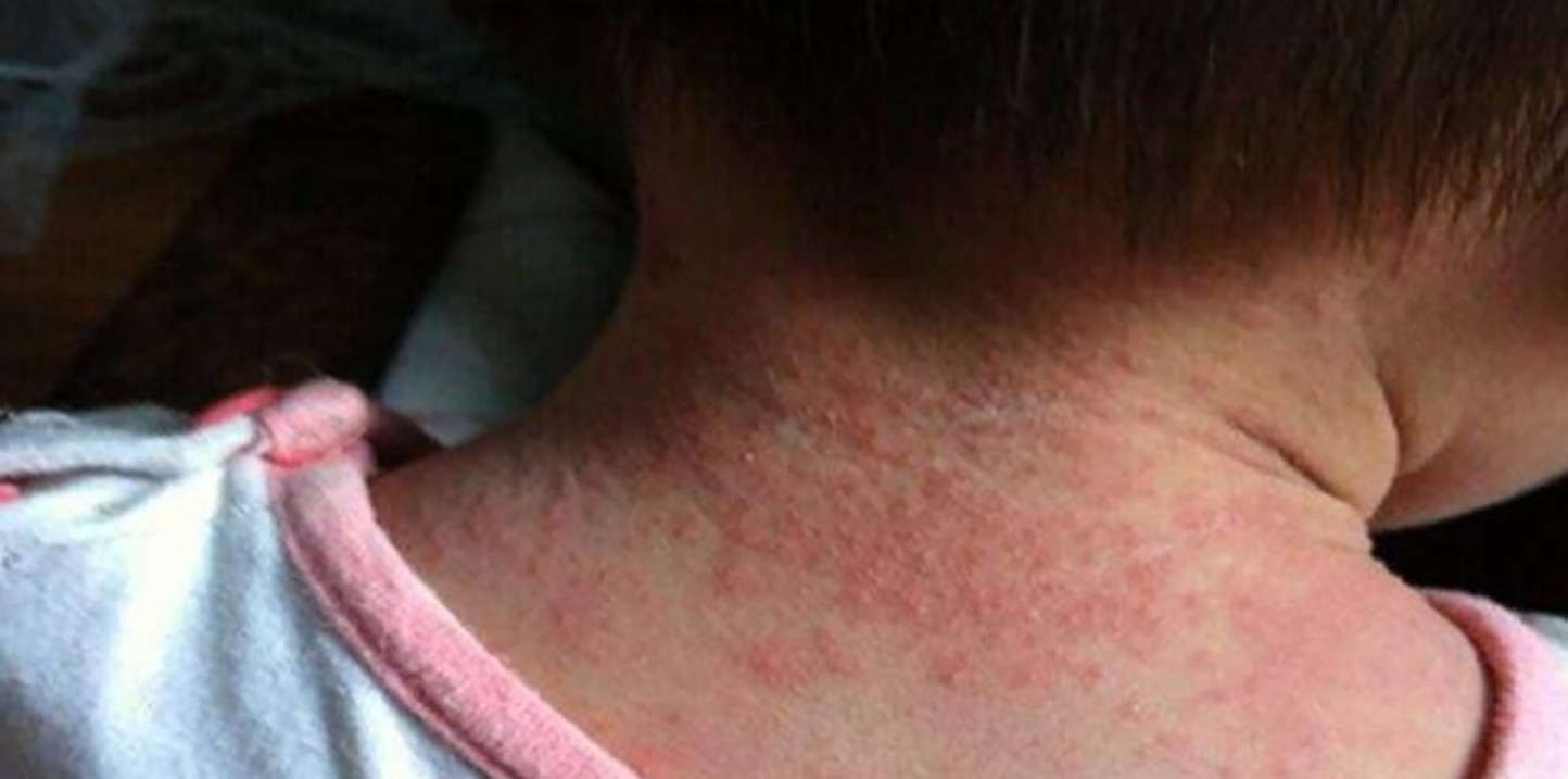 宝宝反复湿疹对付湿疹有妙招,孩子干湿疹反反复复怎么根除