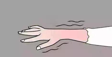 冻疮是因为红斑狼疮吗,冻疮是由于血脉不通引起的吗