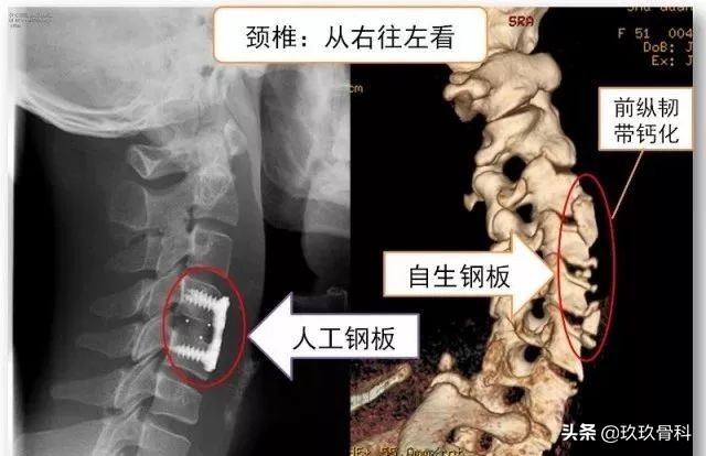 颈椎病治疗的十大误区,颈椎病4大治疗误区你知道吗