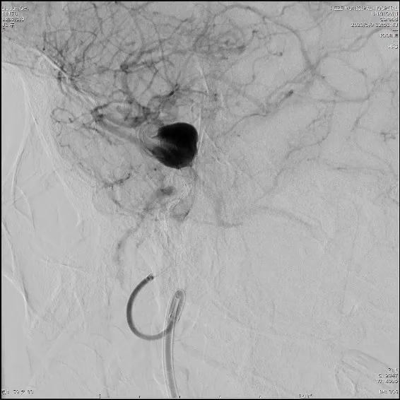 山东治脑动脉瘤最好的专家,菏泽市市立医院血管外科