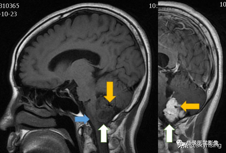 椎体侵袭性血管瘤mri影像学表现,中年妇女脑部血管海绵体瘤的症状