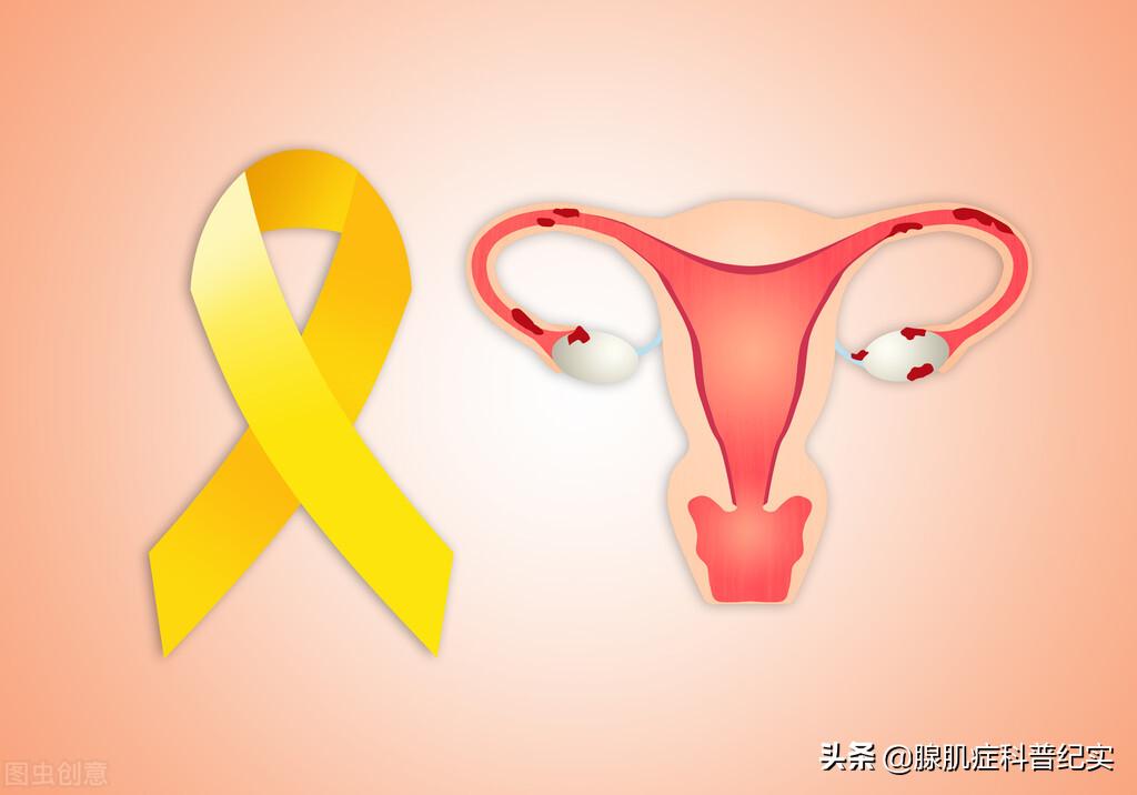 为什么腺肌症会导致痛经,为什么会有腺肌症怎么治疗最有效