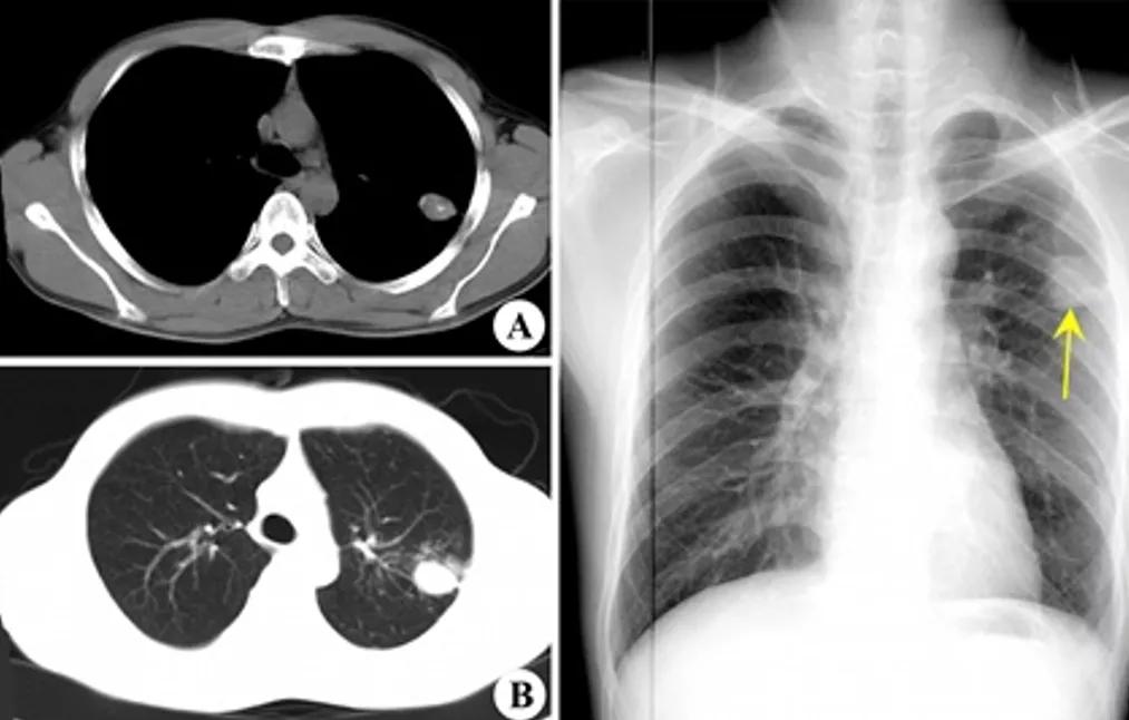 肺结核防控诊疗方案,成功治疗肺结核病的关键