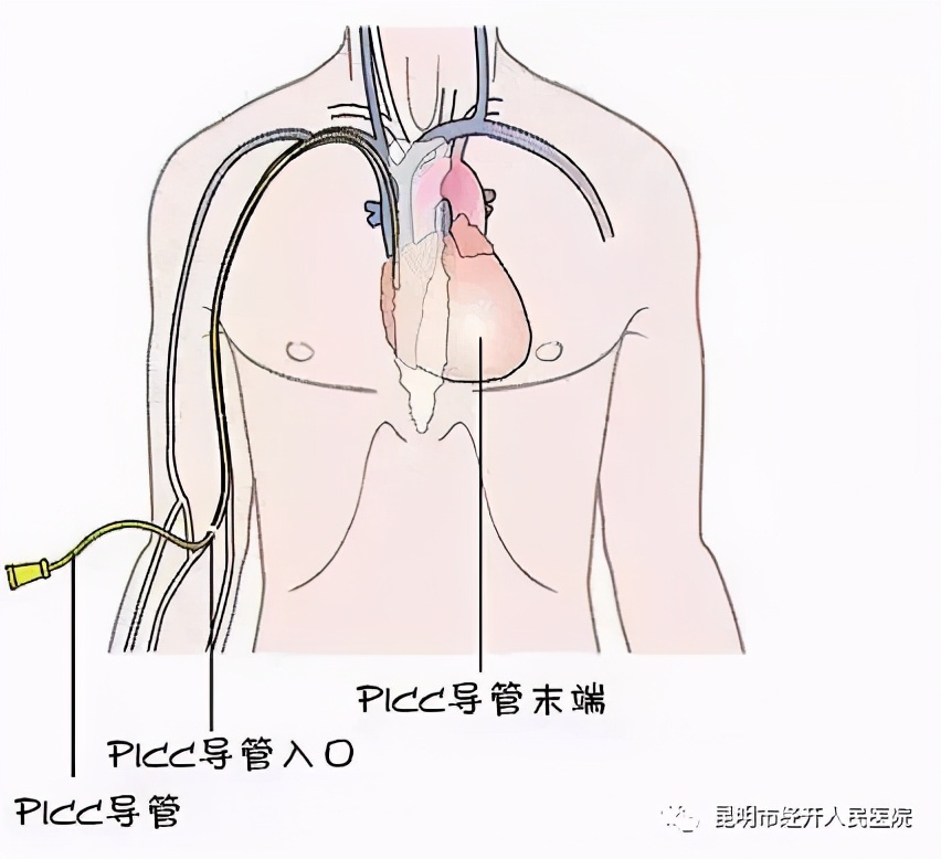picc置管术的护理这些你都要了解,picc置管护理一次多少钱