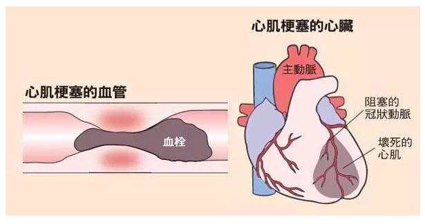 心肌梗死治疗好后有多大风险,心肌梗死导致心脏衰竭能救活吗