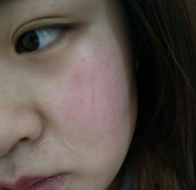 角质层薄的皮肤怎么护理最好,脸颊角质层薄脸会红那要怎么办