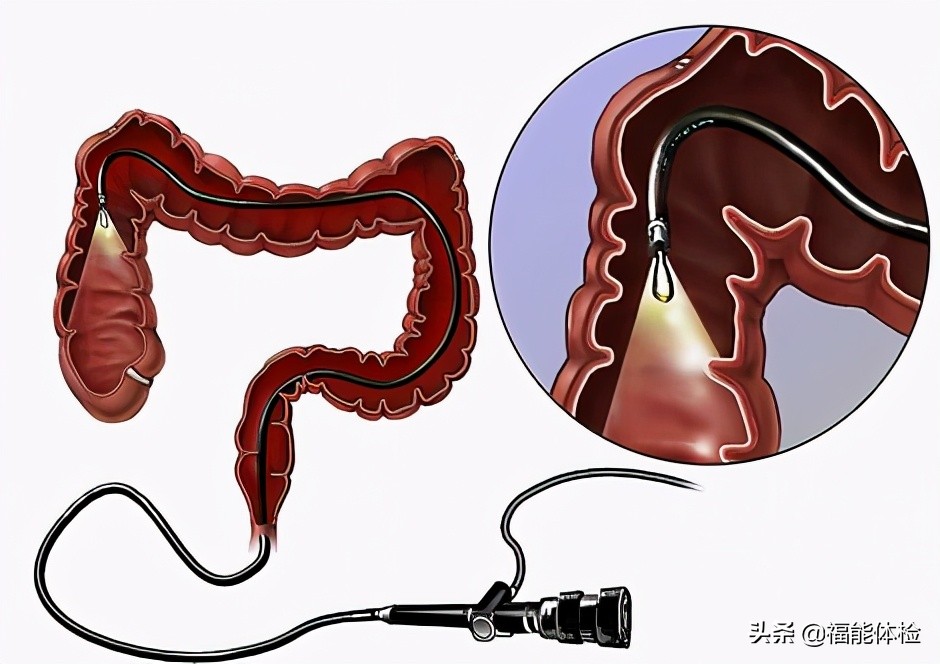 肠息肉切除后多久复查一次肠镜,肠息肉切除后多久复查一次