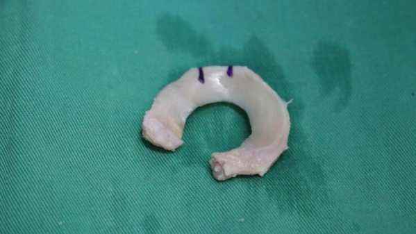 半月板二度损伤适合缝合手术吗,半月板损伤手术缝合效果好吗