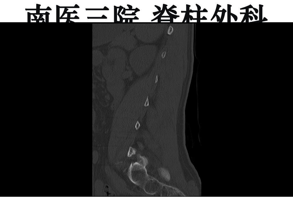 腰痛引起腰椎滑脱怎么治,十七岁腰椎痛怎么办