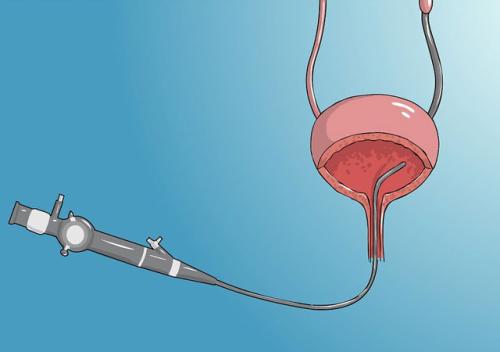 输尿管结石快要掉下来的前兆疼痛,得了结石不治疗会怎样