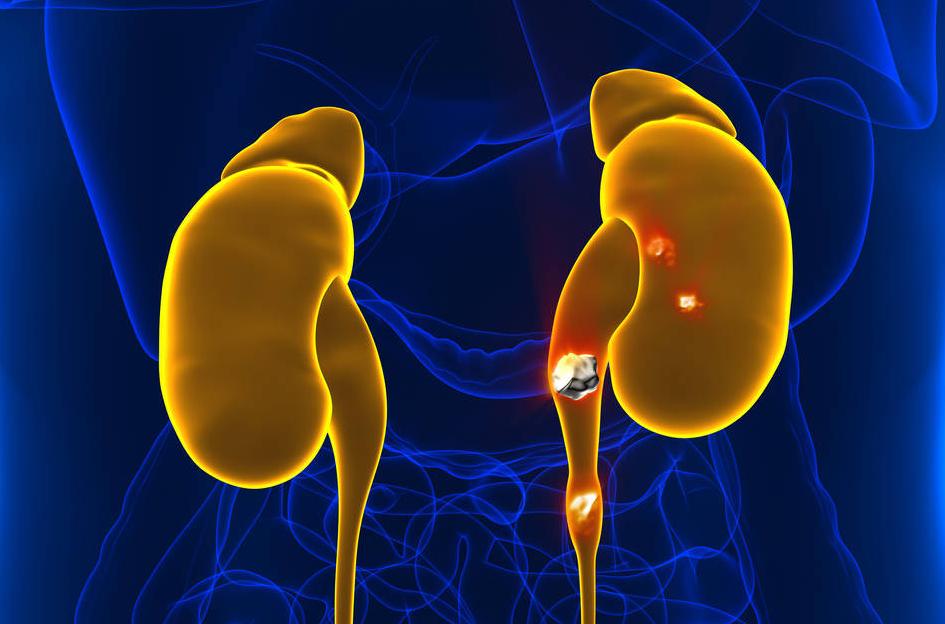 体检查出尿酸高该怎么办,体检发现尿酸高怎么办