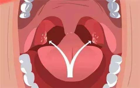 喉咙发炎多喝白开水到底有没有用,喉咙发炎多喝热水有用吗