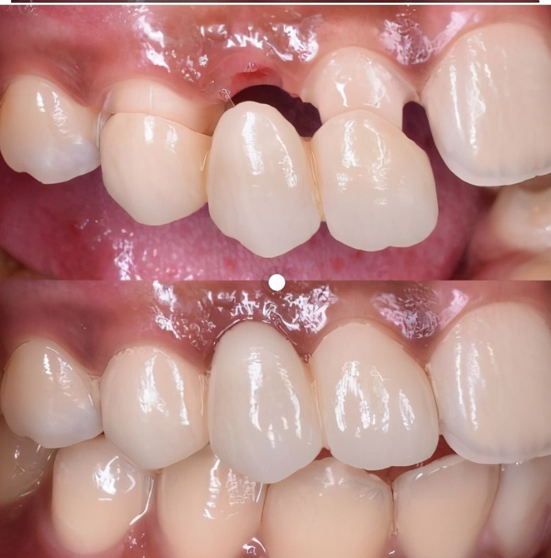 牙科医生讲义第十四讲：什么是 全 瓷 冠