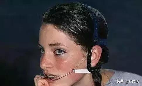 矫正牙齿医生叫打骨钉可以不打吗,正畸打骨钉当天就要挂橡皮筋了吗