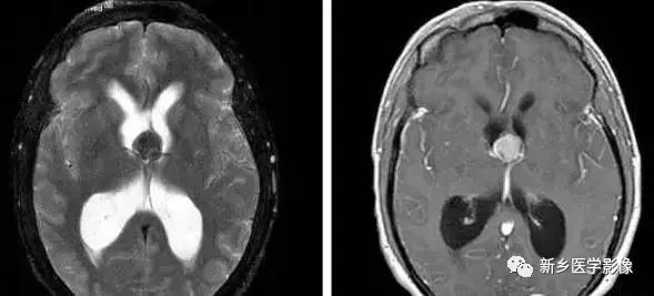 脑室影像学表现,脑室占位影像