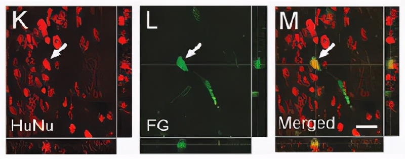 脑梗塞后遗症三年了还可以治愈吗,脑梗塞后遗症能彻底治愈吗