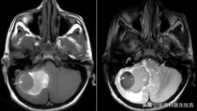 脑出血磁共振各个时期表现,脑出血的分期及磁共振影像学表现