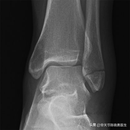 小孩胫骨和腓骨骨折未手术疼多久,14岁腓骨骨折保守治疗还是手术