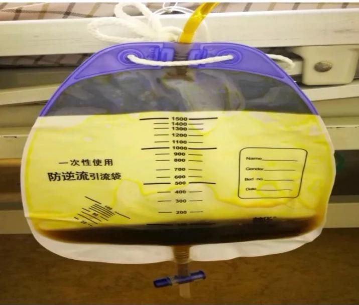 胆管切除后t管脱出怎么办,胆管手术t管脱落有什么症状