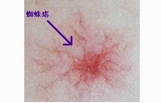 肝不好肝火旺都有哪些明显症状,肝脏不好有哪些症状肝区隐痛