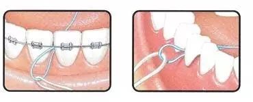 为什么有那么多人矫正牙齿,成年人千万不要做牙齿矫正