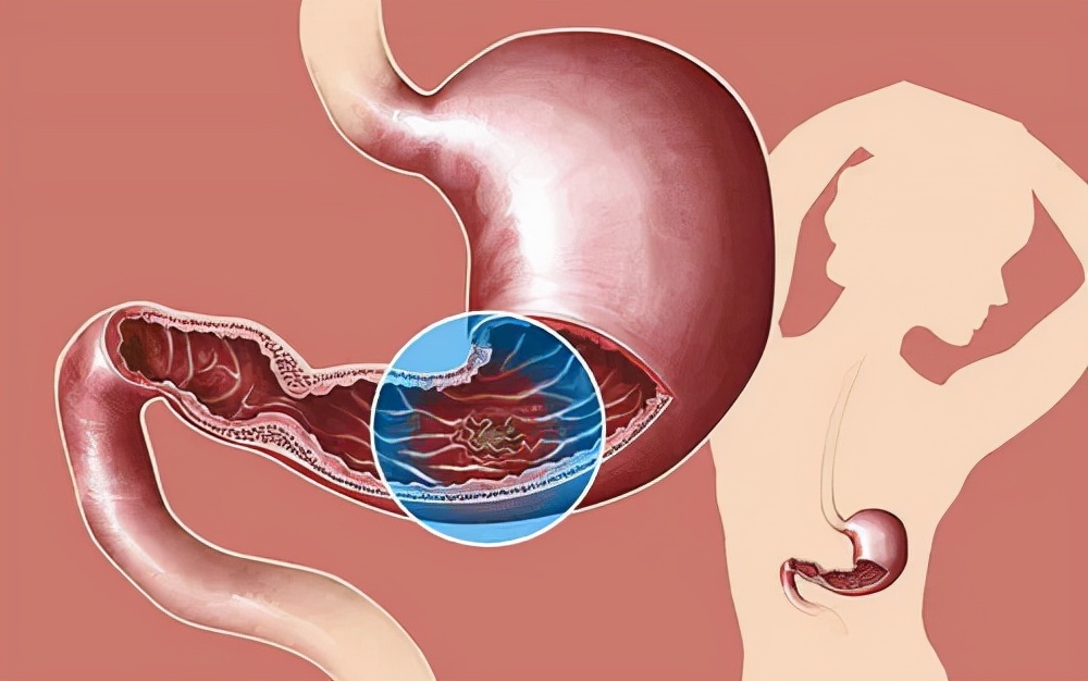 消化性溃疡四联治疗方案,中医治疗消化性溃疡