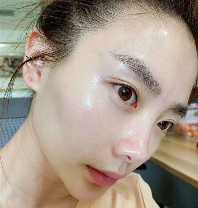 12岁男孩脸上长闭口粉刺如何去掉,脸上闭口粉刺处理方法