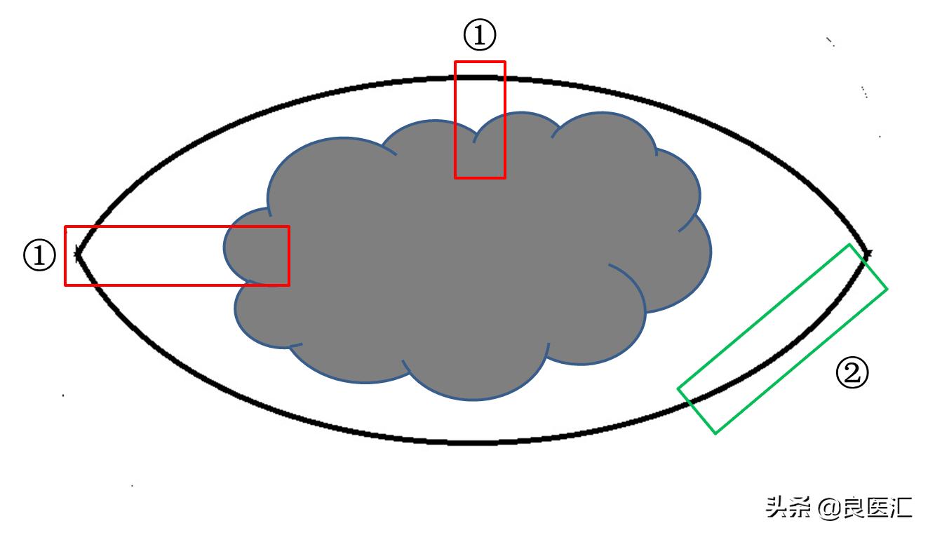 黑色素瘤诊疗规范2018年版,2020年恶性黑色素瘤诊疗指南