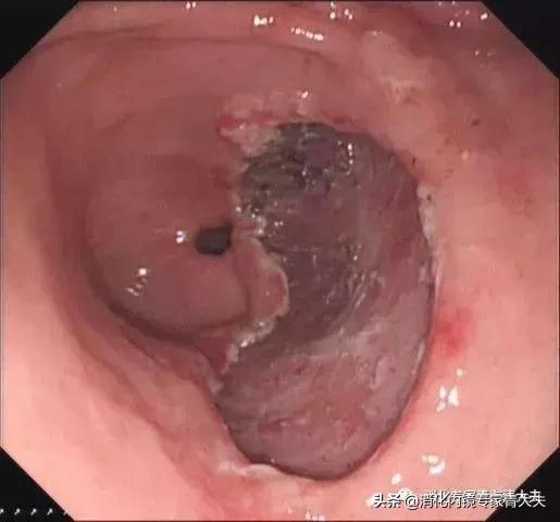 关于胃原位癌的科普文章,消化道早癌科普文章