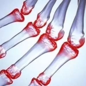 疫情当下也要强身健体,疫情过后得了类风湿