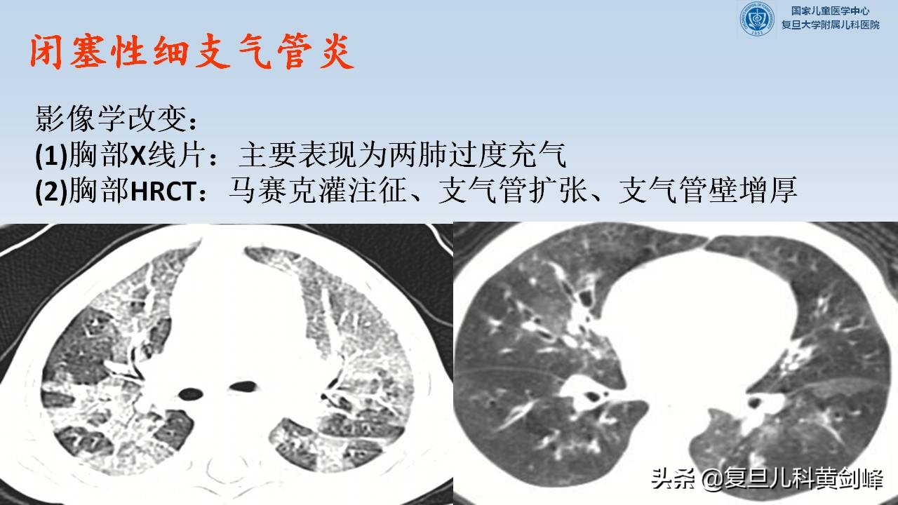 孩子喘一定是肺炎吗,宝宝每次感冒都会喘一定是哮喘吗