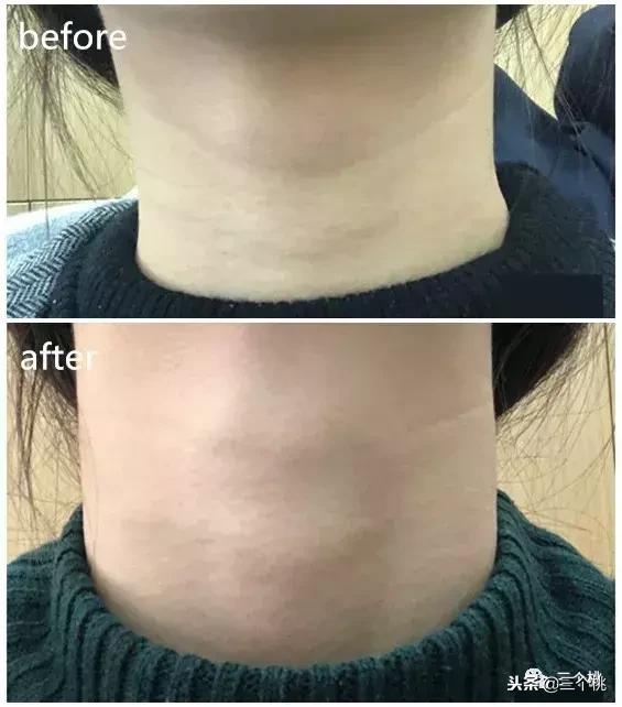 医美去颈纹全过程,去颈纹医美过程