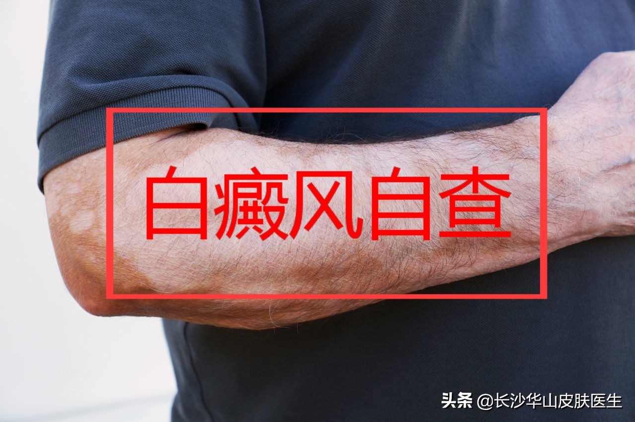 白癜风早期症状为什么会得白癜风,白癜风早期表现和白癜风发病部位