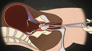 人流最多次案例,20岁女孩人流七次后续